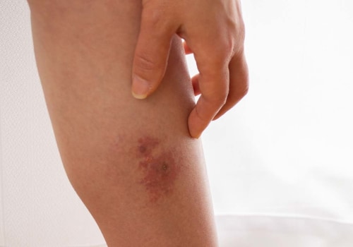 Kan een bloedstolsel in het been cellulitis veroorzaken?